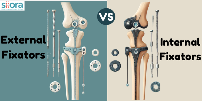 External Fixators vs. Internal Fixators: A Detailed Comparison – Ortho ...